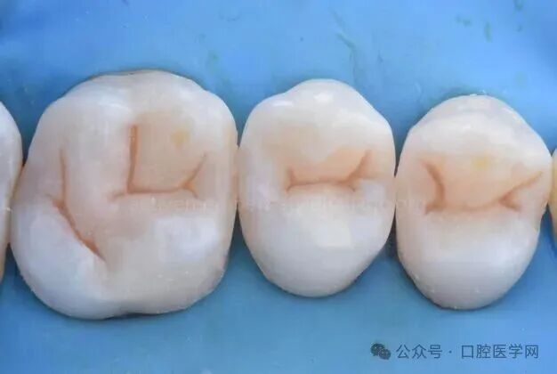 深龋：保守性单次就诊处理