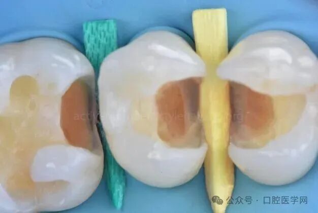 深龋：保守性单次就诊处理