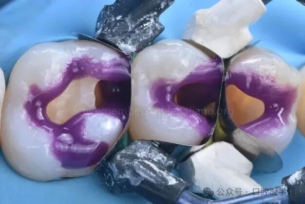 深龋：保守性单次就诊处理