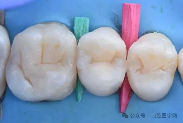 深龋：保守性单次就诊处理