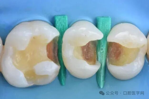 深龋：保守性单次就诊处理