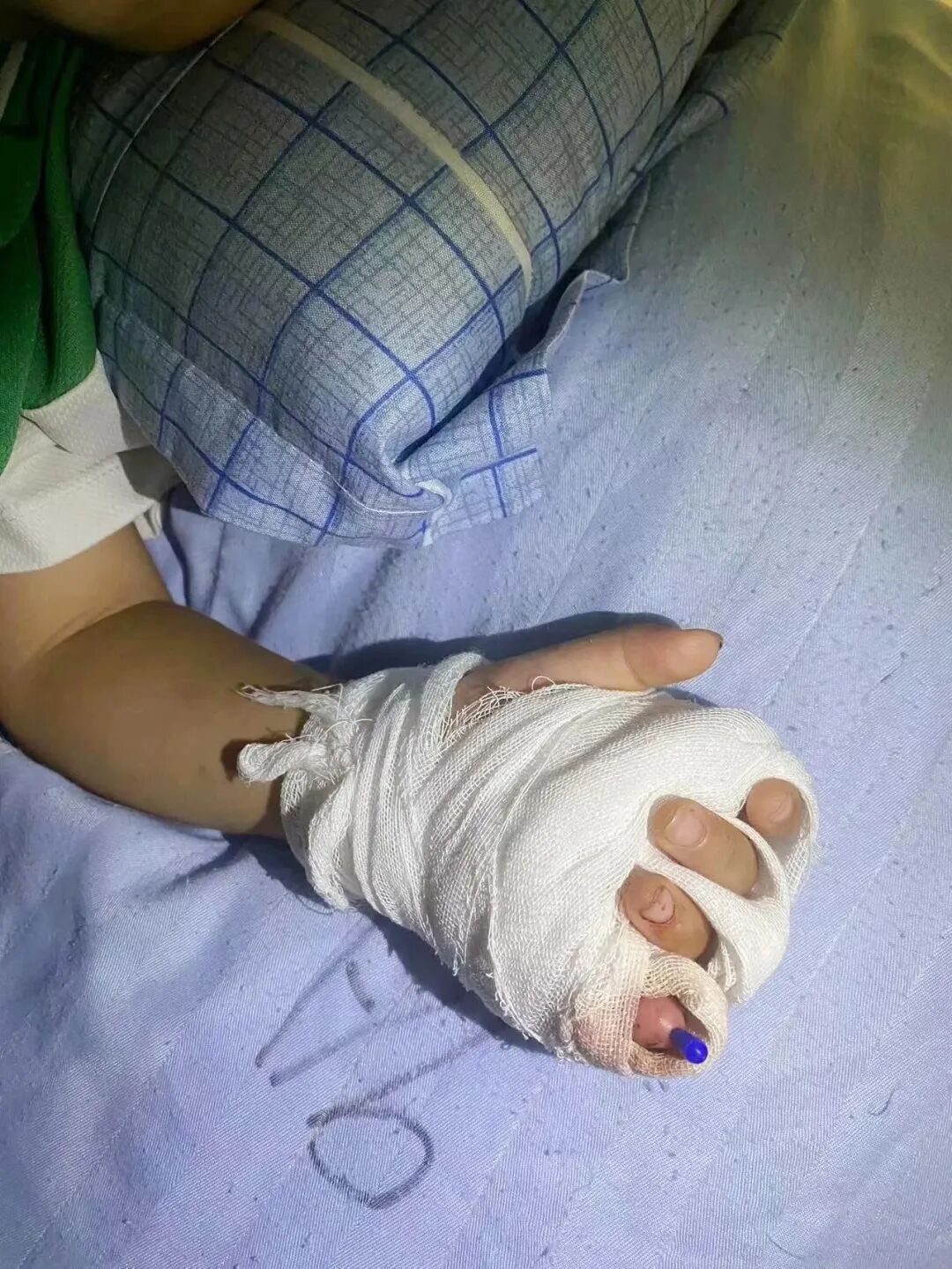 怎么区分显微剪刀揪心 ｜ 他才2岁多，竟敢用剪刀剪断小拇指！_https://www.jmylbn.com_新闻资讯_第9张