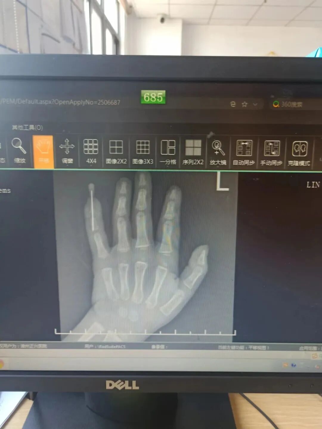 怎么区分显微剪刀揪心 ｜ 他才2岁多，竟敢用剪刀剪断小拇指！_https://www.jmylbn.com_新闻资讯_第8张