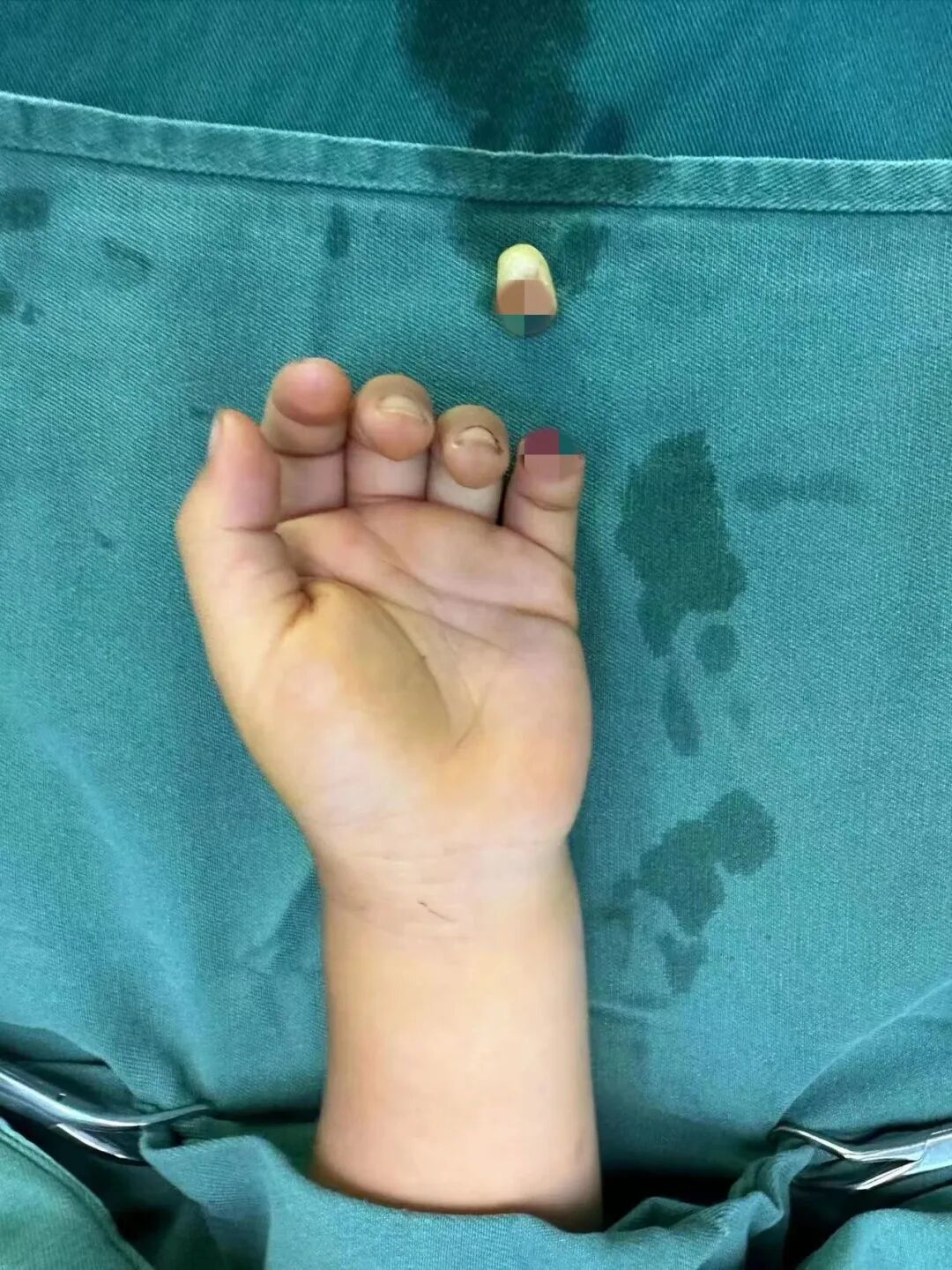 怎么区分显微剪刀揪心 ｜ 他才2岁多，竟敢用剪刀剪断小拇指！_https://www.jmylbn.com_新闻资讯_第5张