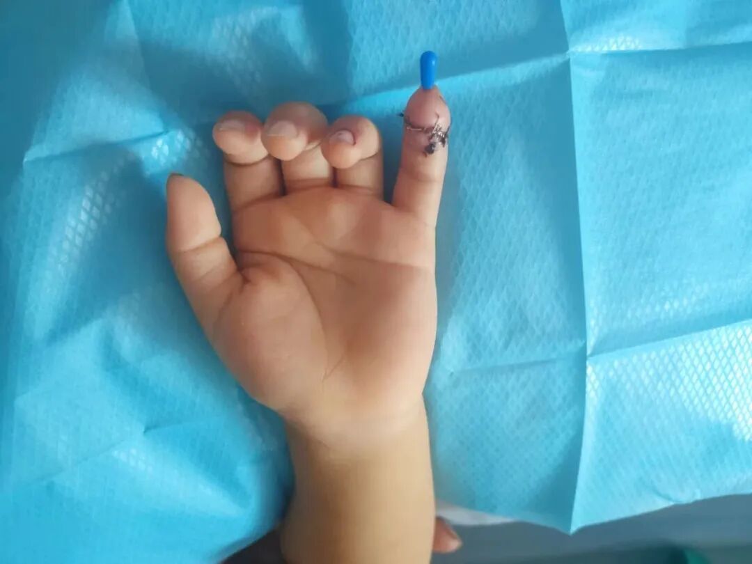 怎么区分显微剪刀揪心 ｜ 他才2岁多，竟敢用剪刀剪断小拇指！_https://www.jmylbn.com_新闻资讯_第10张