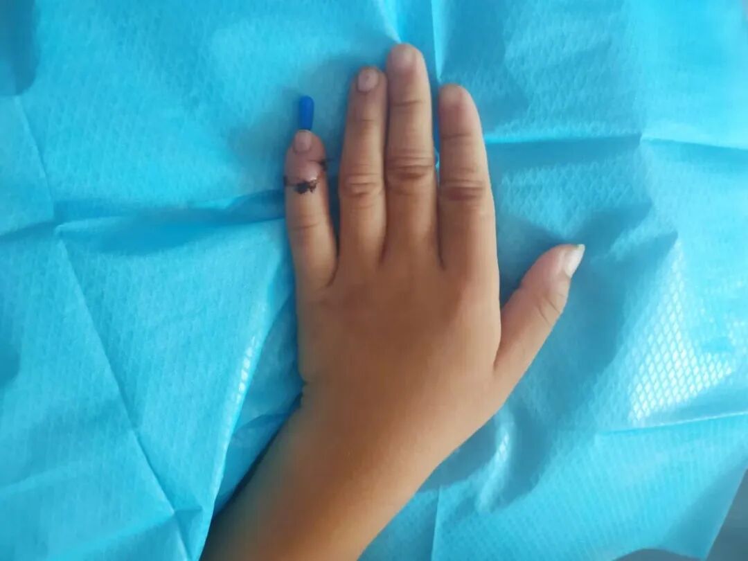 怎么区分显微剪刀揪心 ｜ 他才2岁多，竟敢用剪刀剪断小拇指！_https://www.jmylbn.com_新闻资讯_第11张