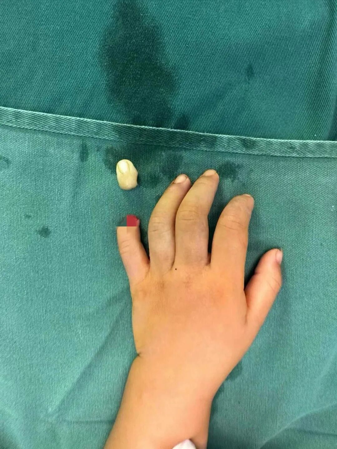 怎么区分显微剪刀揪心 ｜ 他才2岁多，竟敢用剪刀剪断小拇指！_https://www.jmylbn.com_新闻资讯_第4张