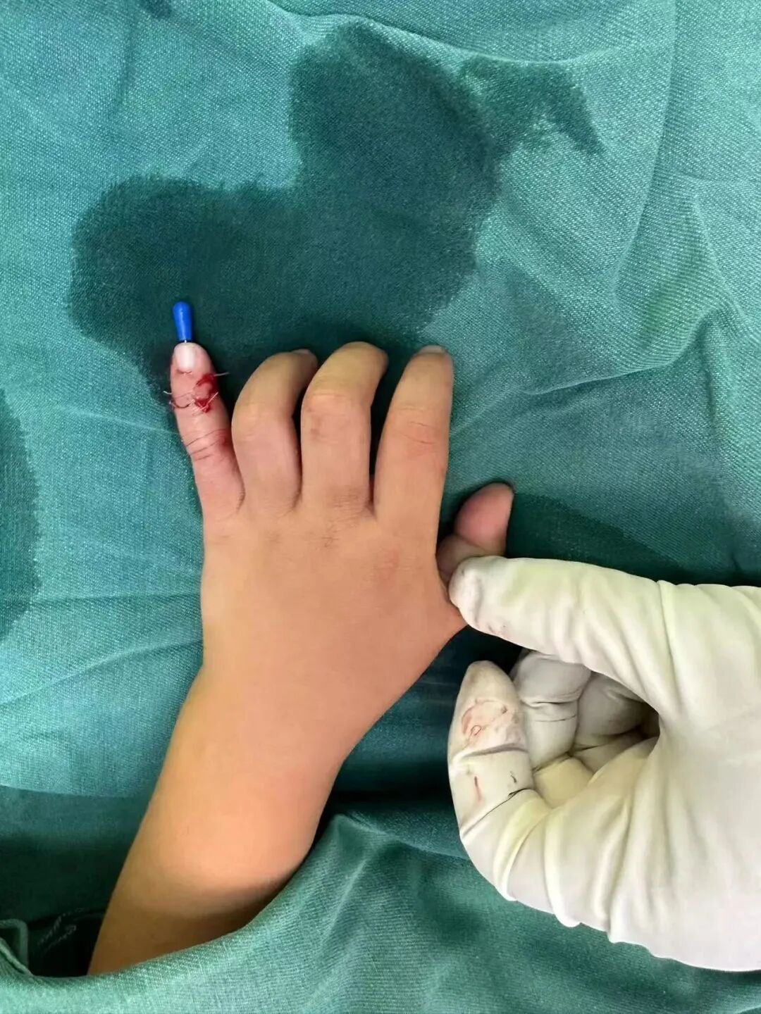 怎么区分显微剪刀揪心 ｜ 他才2岁多，竟敢用剪刀剪断小拇指！_https://www.jmylbn.com_新闻资讯_第7张