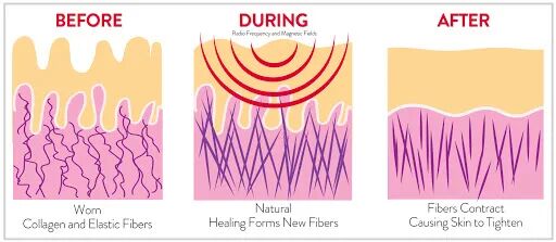 多极射频是什么国产射频美容仪，真的靠谱吗？_https://www.jmylbn.com_新闻资讯_第13张