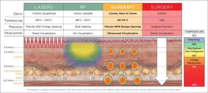 多极射频是什么国产射频美容仪，真的靠谱吗？_https://www.jmylbn.com_新闻资讯_第3张