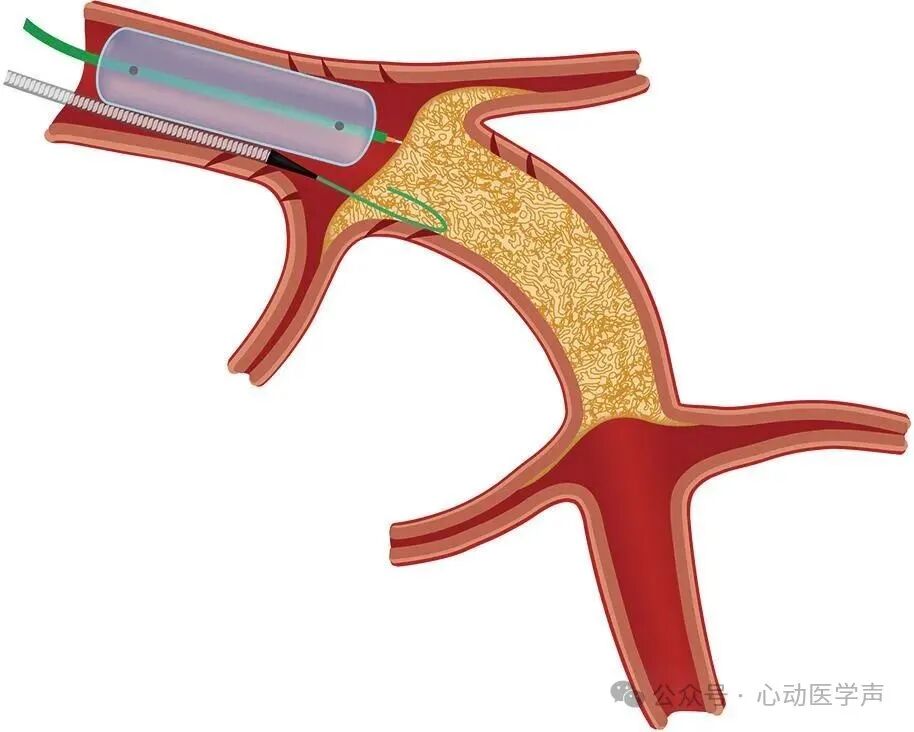 【医学科普】CTO介入路径推荐