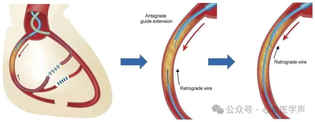 【医学科普】CTO介入路径推荐