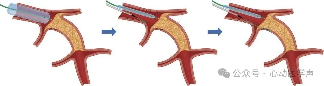 【医学科普】CTO介入路径推荐