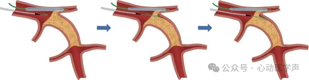 【医学科普】CTO介入路径推荐