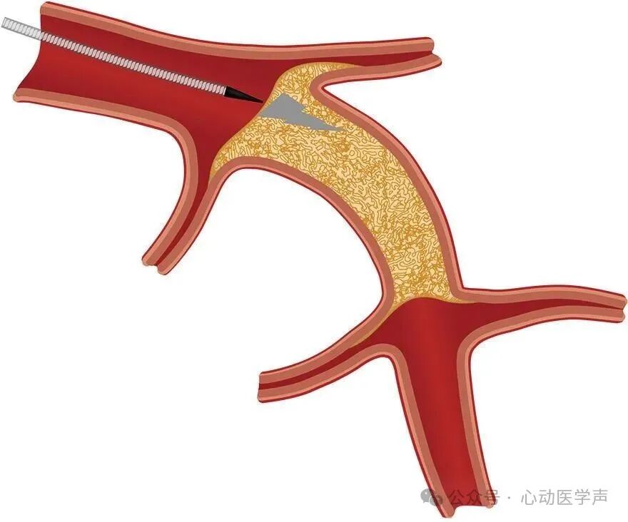 【医学科普】CTO介入路径推荐