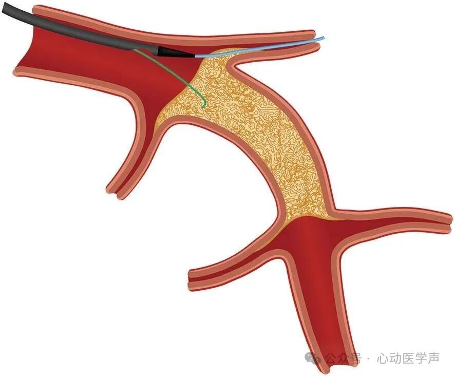 【医学科普】CTO介入路径推荐