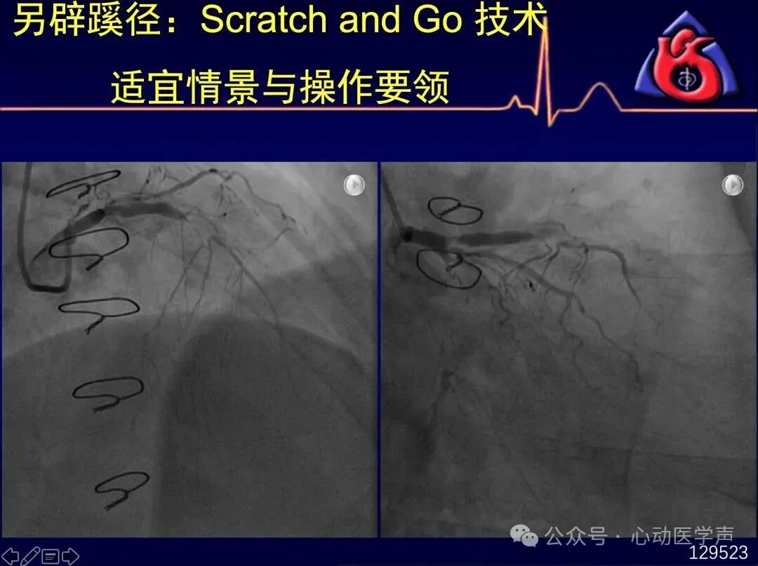 【医学科普】CTO介入路径推荐