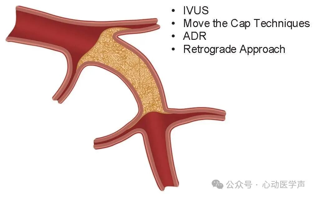 【医学科普】CTO介入路径推荐