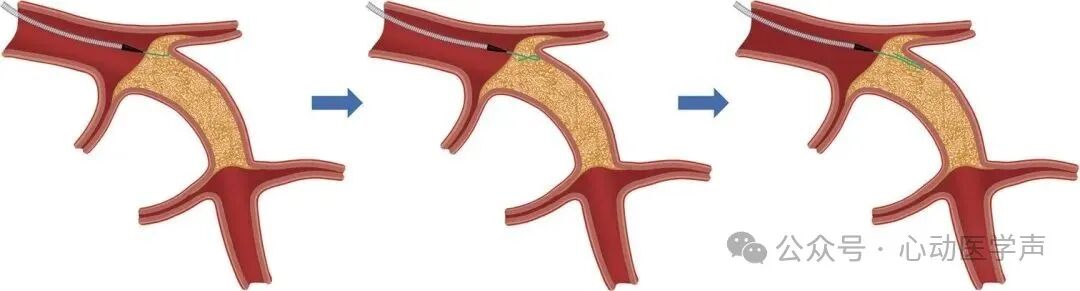 【医学科普】CTO介入路径推荐