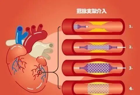 冠心病介入临床干货，赶紧收藏起来！