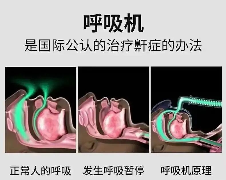带呼吸机为什么还打鼾打鼾使用无创呼吸机的五个好处_https://www.jmylbn.com_新闻资讯_第1张