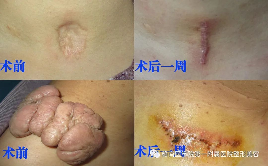 【科普】瘢痕专题之二：疤痕的分类及治疗