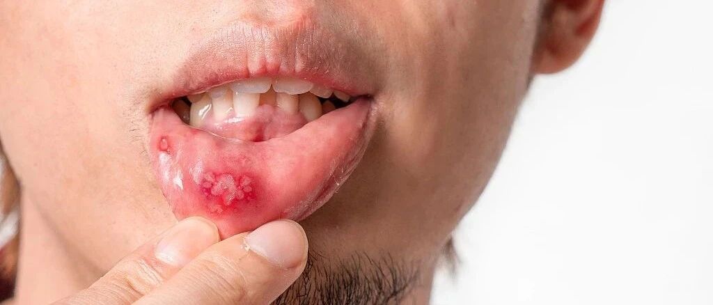 口腔溃疡只会推荐西瓜霜、华素片？还有这14种“特效药”！