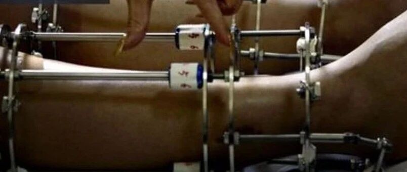 江苏小伙身高不足1米8自卑，到国外断骨增高！结果……