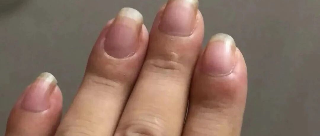 女子指头肿以为小毛病，一查竟是癌症！出现这些信号请务必警惕