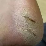 脚后跟粗糙？开裂？渗血？用这招泰国传过来的“秘技”，嫩回细腻鸡蛋白。