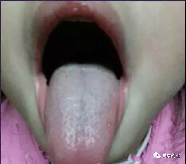 珍贵的舌诊大全 图文并茂 教您看懂舌头 励康药业 微信公众号文章阅读 Wemp