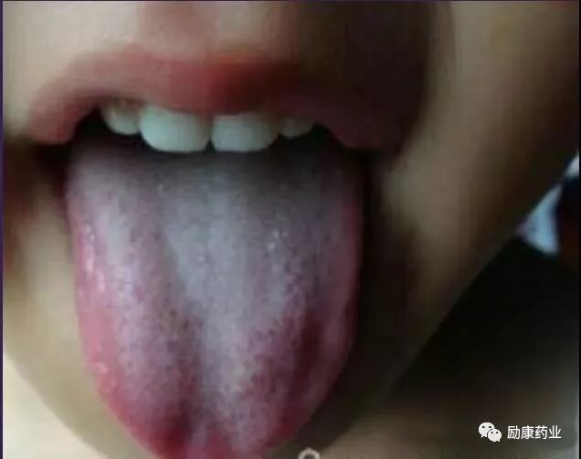 珍贵的舌诊大全 图文并茂 教您看懂舌头 励康药业 微信公众号文章阅读 Wemp