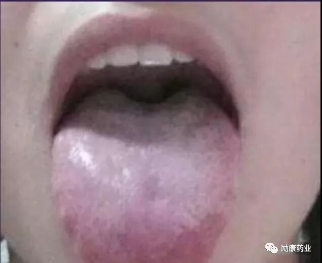 珍贵的舌诊大全 图文并茂 教您看懂舌头 励康药业 微信公众号文章阅读 Wemp