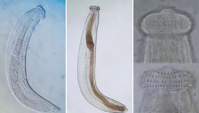 高世同 颚口线虫病的流行病学 临床特点及其诊治 14 文献导读 我爱寄生虫 微信公众号文章阅读 Wemp