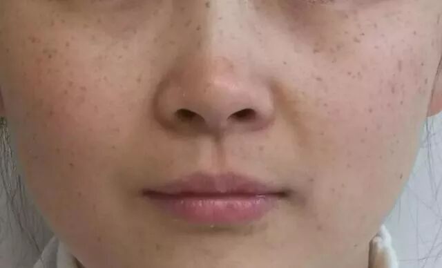 雀斑 斑痣 雀斑样痣 研美吉斑疤痘克星 微信公众号文章阅读 Wemp