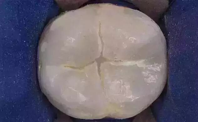 做窝沟封闭的最佳年龄是几岁？