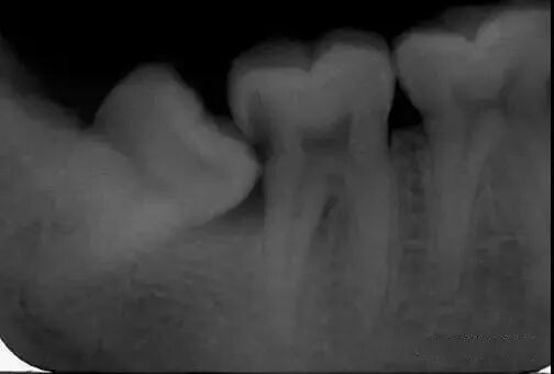 阻生智齿（尽头牙）的危害！