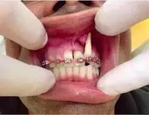 网上买的牙套，不矫正牙反而毁牙， 别交智商税了