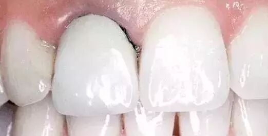 烤瓷牙换全瓷牙，和牙龈黑线说拜拜！