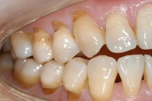 这样刷牙，小心牙齿断裂！