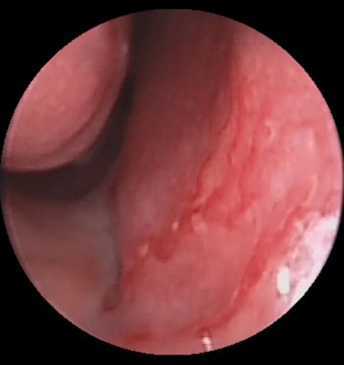 什么是电凝止血鼻子出血不要慌，一招电凝可搞定_https://www.jmylbn.com_新闻资讯_第9张