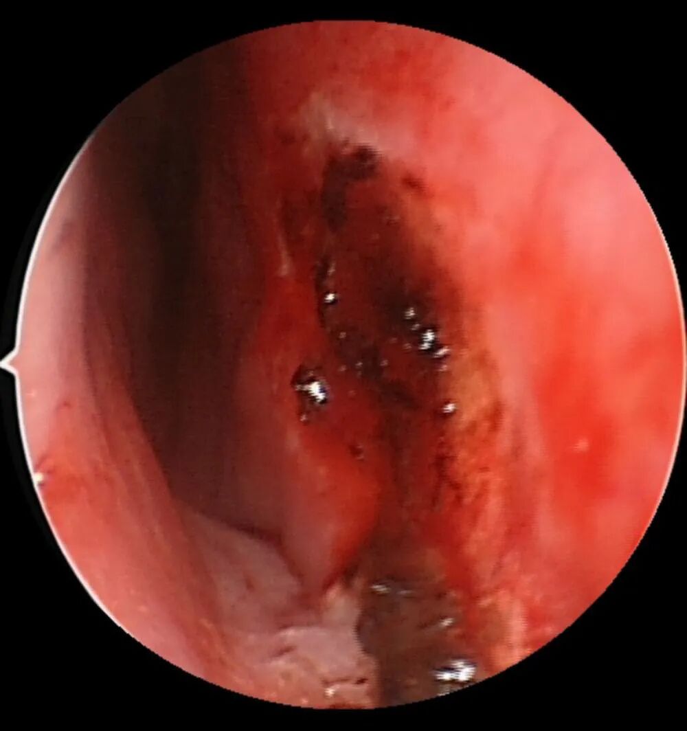 什么是电凝止血鼻子出血不要慌，一招电凝可搞定_https://www.jmylbn.com_新闻资讯_第33张