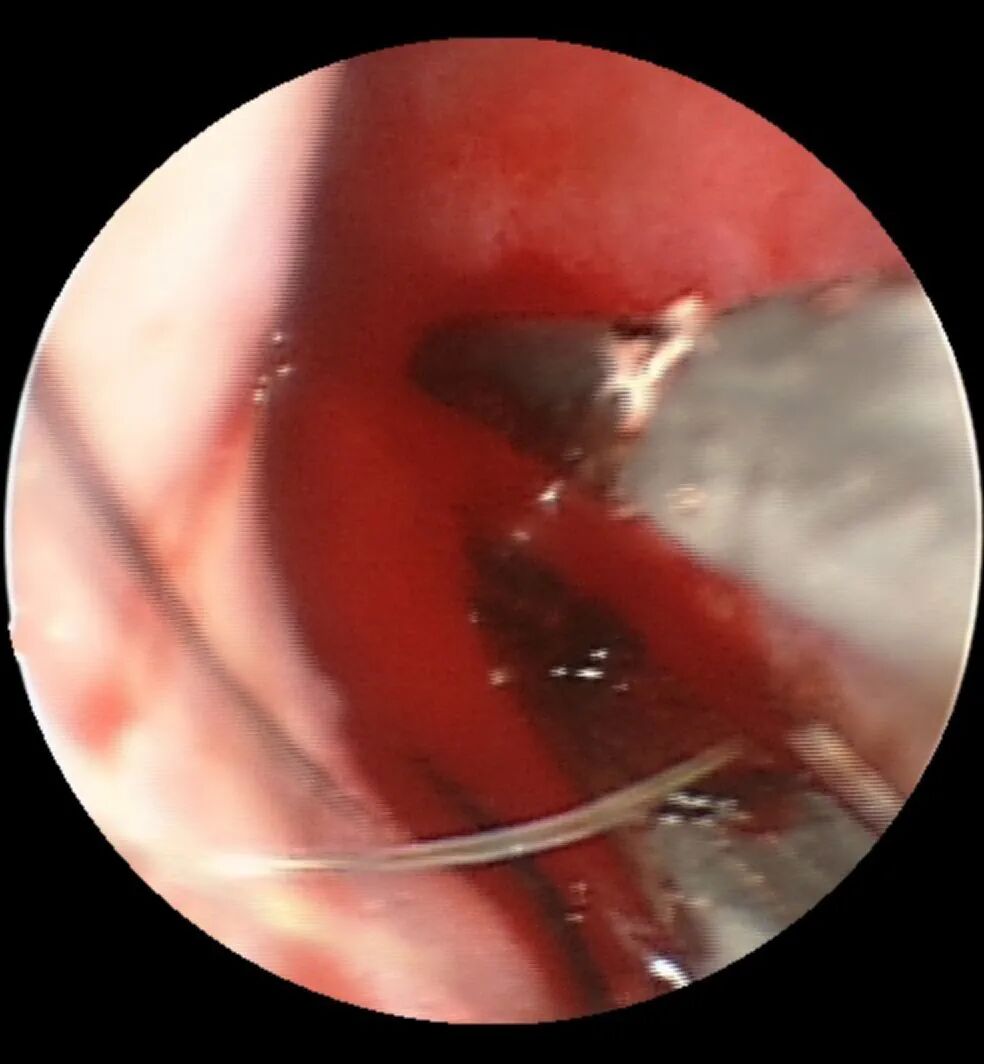 什么是电凝止血鼻子出血不要慌，一招电凝可搞定_https://www.jmylbn.com_新闻资讯_第31张