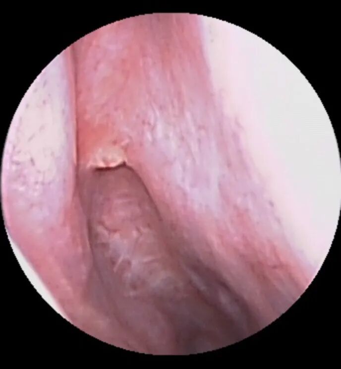 什么是电凝止血鼻子出血不要慌，一招电凝可搞定_https://www.jmylbn.com_新闻资讯_第11张