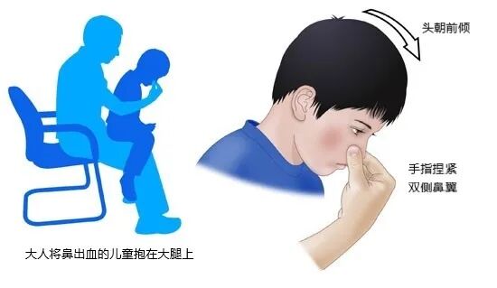 什么是电凝止血鼻子出血不要慌，一招电凝可搞定_https://www.jmylbn.com_新闻资讯_第16张