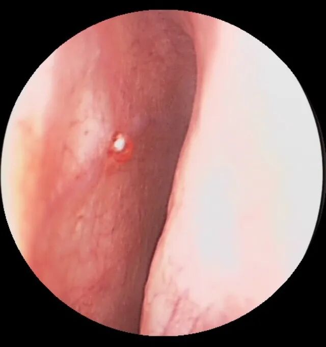 什么是电凝止血鼻子出血不要慌，一招电凝可搞定_https://www.jmylbn.com_新闻资讯_第13张