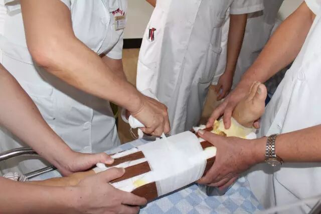 正骨特色疗法岭南李氏骨伤流派疗法:杉树皮夹板外固定