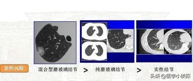 比如我们的实性结节、纯磨玻璃样结节，绝大多数是良性的；但少部分人的
