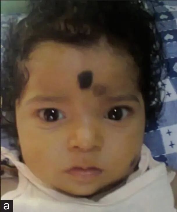 碘-131治疗后出现脱发，是辐射所致？还是另有隐情？