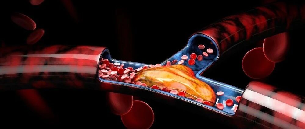 溶栓禁忌证太多记不住？一招轻松掌握
